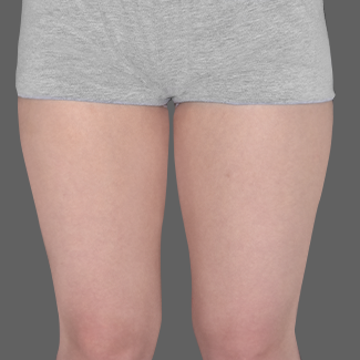 Thigh before